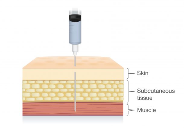 3 Key Factors To Help You Pick The Right Needle For Your Injections ...