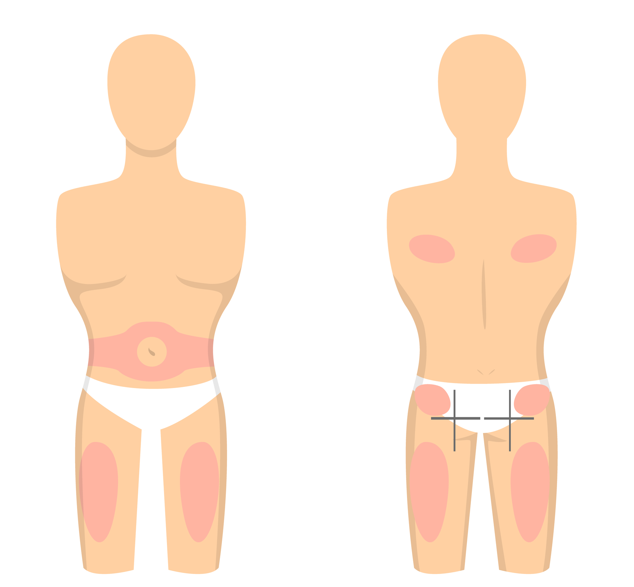 subcutaneous injection sites