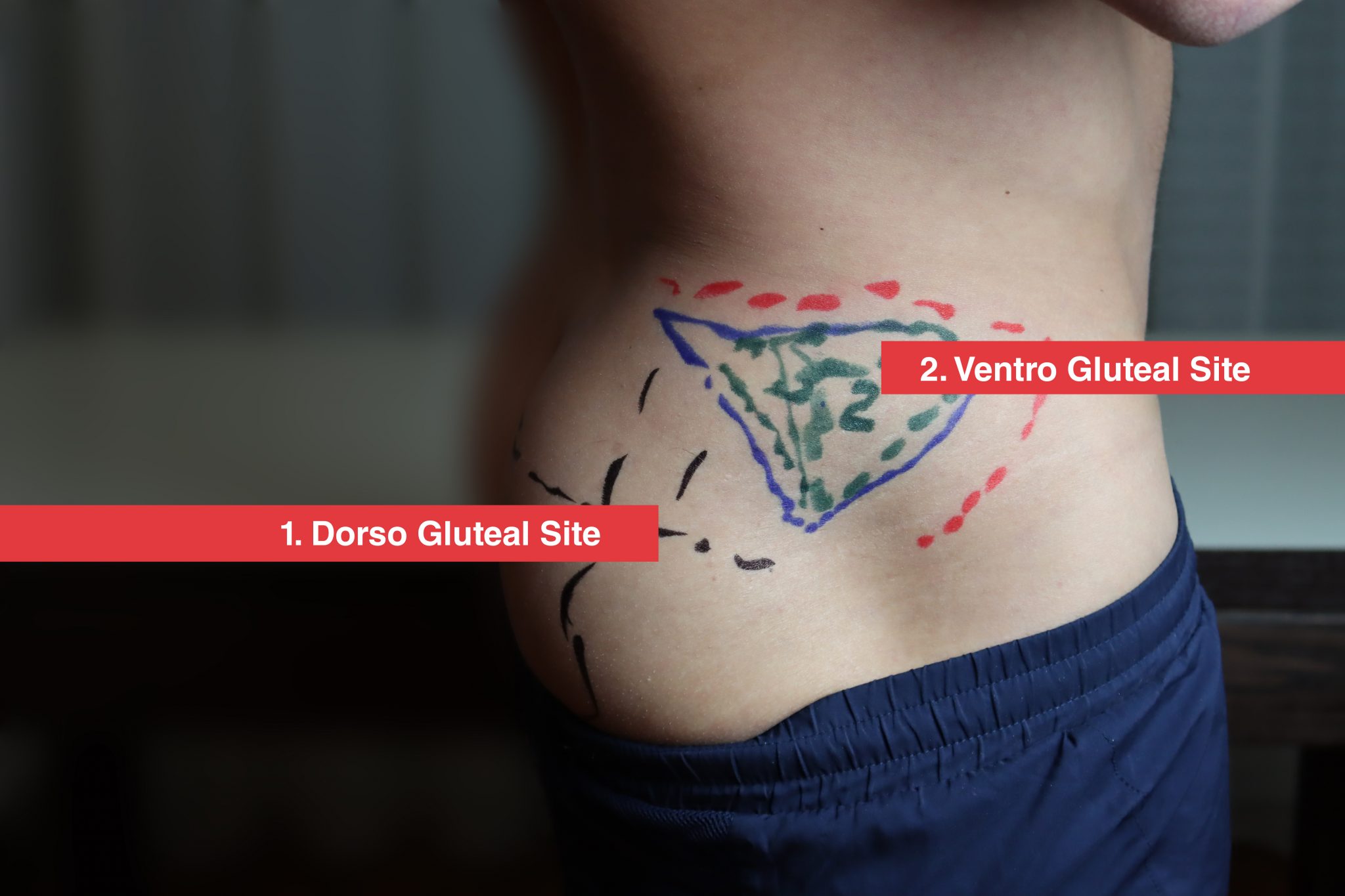 ventrogluteal injection site