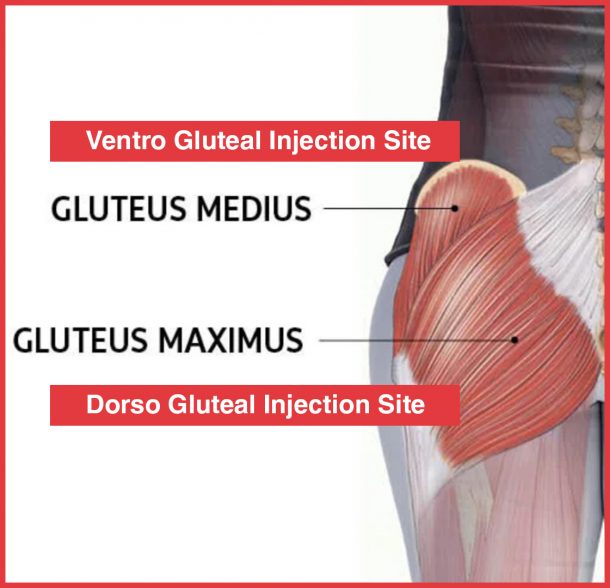 How To Do Ventrogluteal Injection - Glute Injection Guide And Demo ...