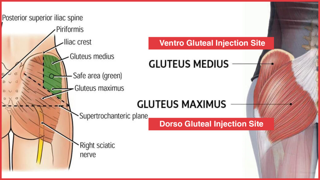 Locate the Ventrogluteal Injection Site